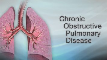 COPDChronic-Pulmonary-Obstructive-Disorder